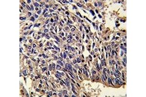 IHC analysis of FFPE human lung carcinoma stained with IL-1 antibody