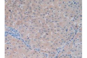 IHC-P analysis of Human Liver Cancer Tissue, with DAB staining. (Vitamin D-Binding Protein 抗体  (AA 209-401))