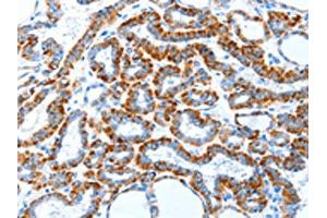 The image on the left is immunohistochemistry of paraffin-embedded Human thyroid cancer tissue using (TLR2 Antibody) at dilution 1/30, on the right is treated with fusion protein. (TLR2 抗体)