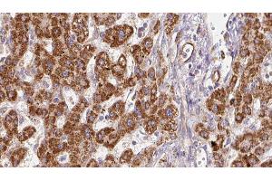 ABIN6278182 at 1/100 staining Human liver cancer tissue by IHC-P. (P2RX7 抗体  (C-Term))