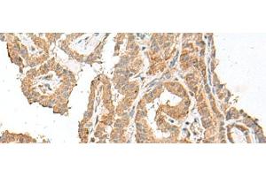 Immunohistochemistry of paraffin-embedded Human thyroid cancer tissue using GART Polyclonal Antibody at dilution of 1:30(x200) (GART 抗体)