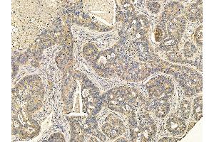 ABIN7095635 and ABIN7099697 at 1/100 staining human liver cancer and adjacent non-tumor tissue by IHC-P.
