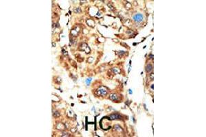Formalin-fixed and paraffin-embedded human hepatocellular carcinoma tissue reacted with MAGI1 polyclonal antibody  , which was peroxidase-conjugated to the secondary antibody, followed by AEC staining. (MAGI1 抗体  (C-Term))