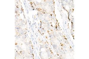 Immunohistochemistry of paraffin-embedded human colon carcinoma using Perilipin-2 antibody (ABIN7269220) at dilution of 1:1600 (40x lens). (ADRP 抗体)