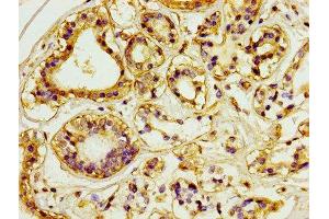 IHC image of ABIN7147154 diluted at 1:100 and staining in paraffin-embedded human breast cancer performed on a Leica BondTM system.