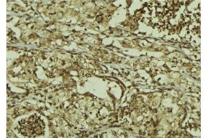 ABIN6267212 at 1/100 staining Human breast cancer tissue by IHC-P. (CDK6 抗体  (pTyr13))