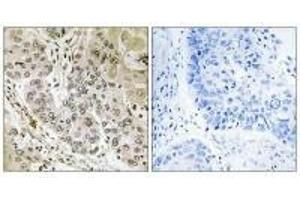 Immunohistochemistry analysis of paraffin-embedded human lung carcinoma tissue, using STK36 antibody. (STK36 抗体)