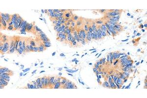 Immunohistochemistry of paraffin-embedded Human colon cancer tissue using GLUT-4 Polyclonal Antibody at dilution 1:70 (GLUT4 抗体)