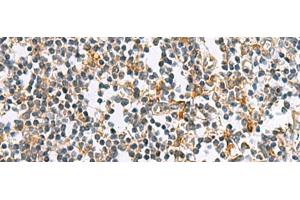 Immunohistochemistry of paraffin-embedded Human tonsil tissue using GUCA1A Polyclonal Antibody at dilution of 1:105(x200)