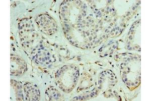 Immunohistochemistry of paraffin-embedded human breast cancer using ABIN7152130 at dilution of 1:100 (EIF1AX 抗体  (AA 10-144))