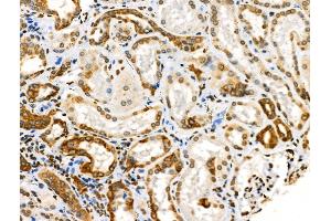 Phospho-Cytokeratin 18 (Ser53) Antibody at 1/100 staining Human kidney cancer and adjacent normal tissues by IHC-P. (Cytokeratin 18 抗体  (pSer53))