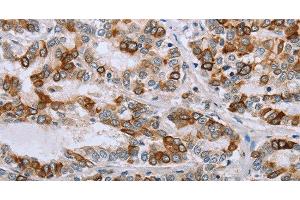 Immunohistochemistry of paraffin-embedded Human liver cancer tissue using NMT1 Polyclonal Antibody at dilution 1:45 (NMT1 抗体)