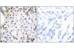Immunohistochemistry analysis of paraffin-embedded human breast carcinoma tissue, using Retinoid X Receptor gamma Antibody. (Retinoid X Receptor gamma 抗体  (AA 171-220))