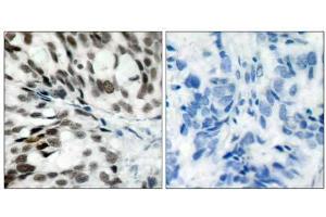 Immunohistochemical analysis of paraffin- embedded human breast carcinoma tissue using Rb (Ab-780) antibody (E021110). (Retinoblastoma 1 抗体)