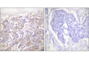 Immunohistochemistry analysis of paraffin-embedded human breast carcinoma tissue, using TNF Receptor I Antibody. (TNFRSF1A 抗体  (AA 381-430))