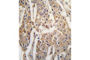 Formalin-fixed and paraffin-embedded human breast carcinoma tissue reacted with PKM2 antibody (C-term ) (ABIN391256 and ABIN2841316) , which was peroxidase-conjugated to the secondary antibody, followed by DAB staining. (PKM2 抗体  (C-Term))