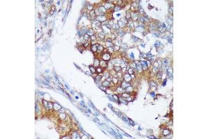 Immunohistochemistry of paraffin-embedded Human colon carcinoma using R Rabbit pAb (ABIN7269785) at dilution of 1:100 (40x lens). (RABGAP1 抗体  (AA 830-1069))
