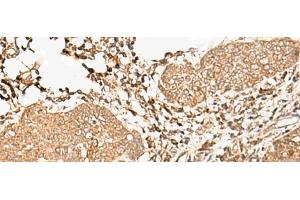 Immunohistochemistry of paraffin-embedded Human esophagus cancer tissue using FER Polyclonal Antibody at dilution of 1:90(x200) (FER 抗体)