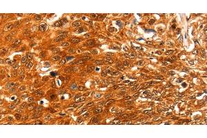 Immunohistochemistry of paraffin-embedded Human esophagus cancer using SERPINB5 Polyclonal Antibody at dilution of 1:60 (SERPINB5 抗体)