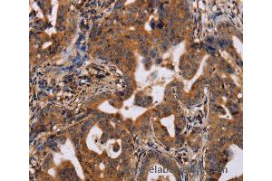 Immunohistochemistry of Human prostate cancer using IL12RB2 Polyclonal Antibody at dilution of 1:40 (IL12RB2 抗体)