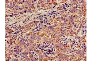 IHC image of ABIN7150697 diluted at 1:300 and staining in paraffin-embedded human pancreatic cancer performed on a Leica BondTM system. (MEK1 抗体  (AA 2-79))
