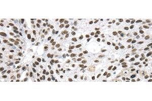 Immunohistochemistry of paraffin-embedded Human breast cancer using DDX39B Polyclonal Antibody at dilution of 1/40 (DDX39B 抗体)