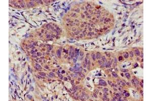 Immunohistochemistry of paraffin-embedded human colon cancer using ABIN7169527 at dilution of 1:100 (TRPC1 抗体  (AA 39-207))