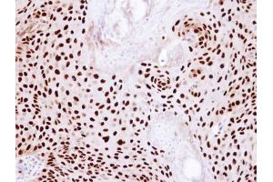 IHC-P Image Immunohistochemical analysis of paraffin-embedded Cal27 Xenograft, using Ku80 (XRCC5), antibody at 1:100 dilution. (X-Ray Repair Cross Complementing 5 抗体)