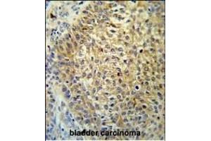 T Antibody (Center) (ABIN651323 and ABIN2840187) IHC analysis in formalin fixed and paraffin embedded bladder carcinoma followed by peroxidase conjugation of the secondary antibody and DAB staining. (TMEM222 抗体  (AA 107-135))