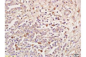 Formalin-fixed and paraffin embedded human pulmonitis labeled with Anti-IL-18R Beta/IL1R7/CD218b Polyclonal Antibody, Unconjugated (ABIN748058) at 1:200 followed by conjugation to the secondary antibody and DAB staining (IL18RAP 抗体  (AA 15-120))
