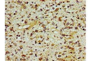 Immunohistochemistry of paraffin-embedded human glioma using ABIN7156245 at dilution of 1:100 (ING1 抗体  (AA 260-353))
