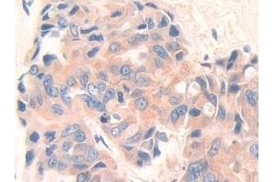 Detection of DEP1 in Human Breast cancer Tissue using Polyclonal Antibody to Density Enhanced Phosphatase 1 (DEP1) (PTPRJ 抗体  (AA 1061-1293))