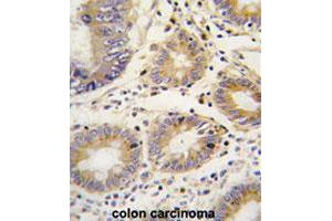 Formalin-fixed and paraffin-embedded human colon carcinomareacted with LEFTY1 polyclonal antibody , which was peroxidase-conjugated to the secondary antibody, followed by AEC staining. (LEFTY1 抗体  (AA 291-320))