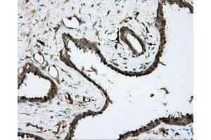 Immunohistochemical staining of paraffin-embedded Carcinoma of prostate tissue using anti-BTK mouse monoclonal antibody. (BTK 抗体)