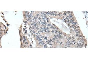 Immunohistochemistry of paraffin-embedded Human colorectal cancer tissue using UFM1 Polyclonal Antibody at dilution of 1:45(x200) (UFM1 抗体)