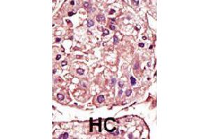 Formalin-fixed and paraffin-embedded human hepatocellular carcinoma tissue reacted with TGFBR1 polyclonal antibody  , which was peroxidase-conjugated to the secondary antibody, followed by AEC staining. (TGFBR1 抗体  (Internal Region))