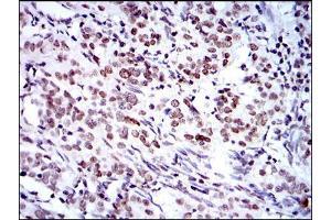Immunohistochemical analysis of paraffin-embedded cervical cancer tissues using BMI1 mouse mAb with DAB staining.