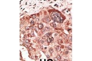 Formalin-fixed and paraffin-embedded human cancer tissue reacted with the primary antibody, which was peroxidase-conjugated to the secondary antibody, followed by DAB staining. (Recoverin 抗体  (C-Term))