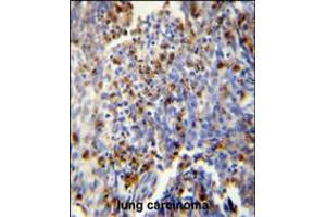 FOSL2 antibody immunohistochemistry analysis in formalin fixed and paraffin embedded human lung carcinoma followed by peroxidase conjugation of the secondary antibody and DAB staining. (FOSL2 抗体  (AA 95-122))