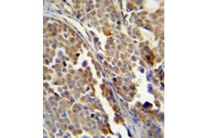 Immunohistochemical staining of formalin-fixed and paraffin-embedded human skin carcinoma reacted with ALDH3A2 monoclonal antibody  at 1:50-1:100 dilution. (ALDH3A2 抗体)