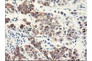 Immunohistochemical staining of paraffin-embedded Carcinoma of Human lung tissue using anti-EIF2B3 mouse monoclonal antibody. (EIF2B3 抗体)