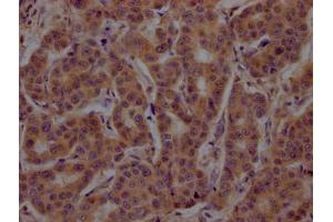 IHC image of ABIN7148794 diluted at 1:200 and staining in paraffin-embedded human breast cancer performed on a Leica BondTM system. (ATF4 抗体  (AA 20-200))