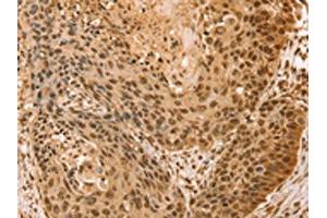 The image on the left is immunohistochemistry of paraffin-embedded Human esophagus cancer tissue using ABIN7131133(SNX8 Antibody) at dilution 1/25, on the right is treated with fusion protein. (SNX8 抗体)