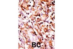 Formalin-fixed and paraffin-embedded human cancer tissue reacted with the primary antibody, which was peroxidase-conjugated to the secondary antibody, followed by AEC staining. (BAD 抗体  (pSer99))
