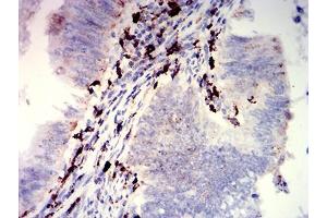 Immunohistochemical analysis of paraffin-embedded rectum cancer tissues using CD274 mouse mAb with DAB staining. (PD-L1 抗体  (AA 24-153))