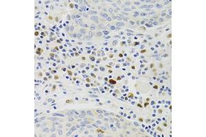 Immunohistochemistry of paraffin-embedded human lung cancer using GEMIN2 Antibody. (SIP1 抗体)