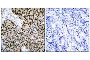 Immunohistochemical analysis of paraffin-embedded human breast carcinoma tissue using HSF1 (Ab-303) antibody (E021255). (HSF1 抗体)