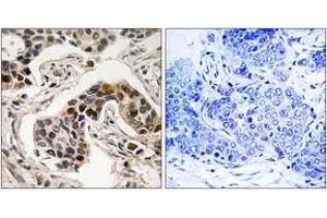 Immunohistochemistry analysis of paraffin-embedded human breast carcinoma, using NudC (Phospho-Ser326) Antibody. (NUDC 抗体  (pSer326))