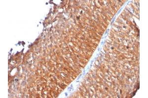 Formalin-fixed, paraffin-embedded human Bladder Carcinoma stained with Mitochondria Monoclonal Antibody (MTC719) (Mitochondrial Marker 抗体)