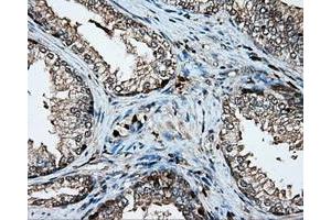 Immunohistochemical staining of paraffin-embedded Adenocarcinoma of colon tissue using anti-PLEK mouse monoclonal antibody. (Pleckstrin 抗体)
